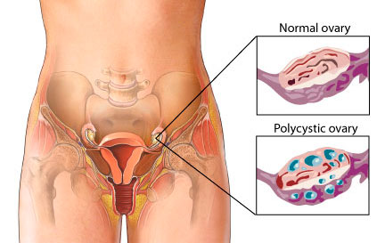 PCOS szindróma méhpempővel